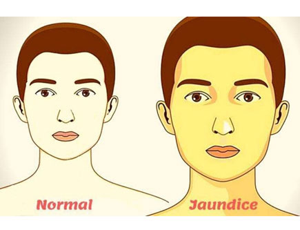 Jaundice