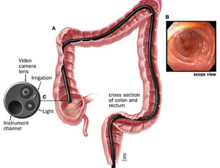 Colonoscopy