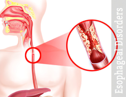 Esophageal Disorders