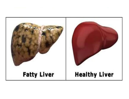 Fatty Liver