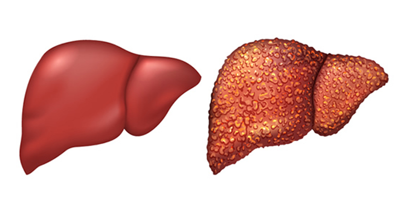 Home care for chronic liver disease