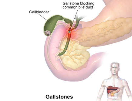 Gallstones