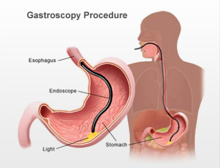 Gastroscopy