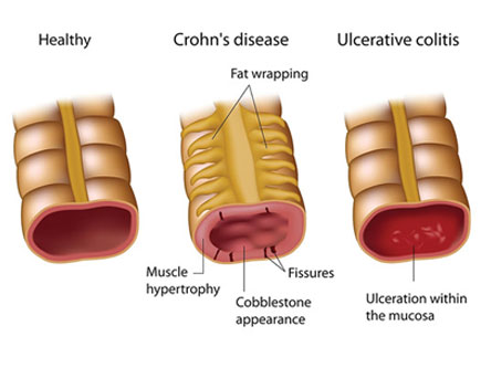Inflammatory Bowel Disease
