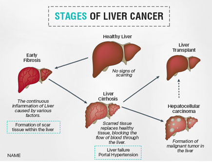 Liver Cancers