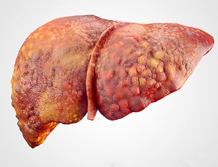 Liver Cirhosis