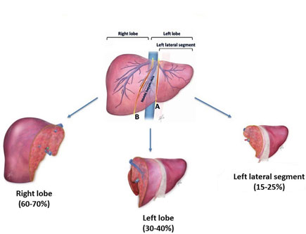 Liver Transplant