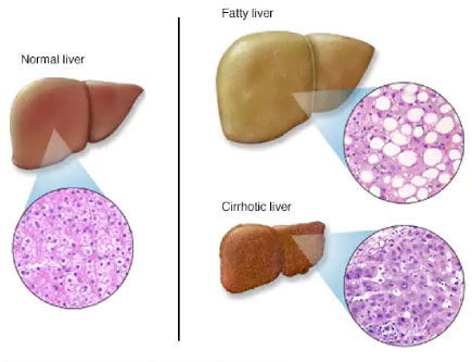 Liver disorders