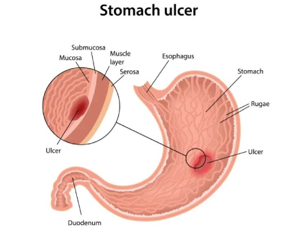 Stomach Ulcers
