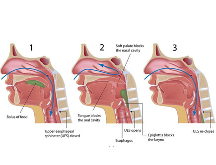 Difficulty in Swallowing